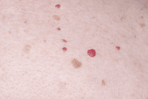 Cherry Angiomas