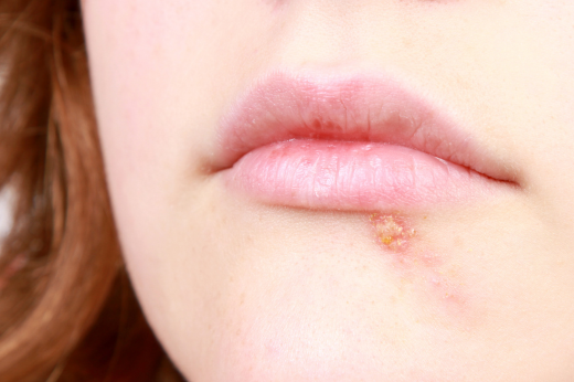 Cold sores and fever blisters