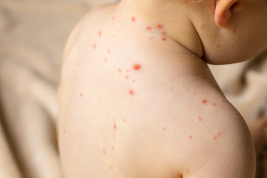 Chickenpox and shingles