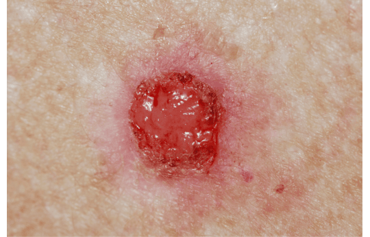 Basal Cell Carcinoma