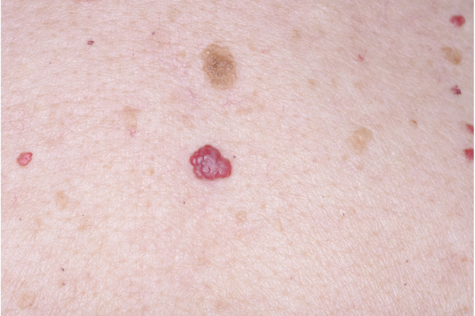 Infantile Hemangiomas