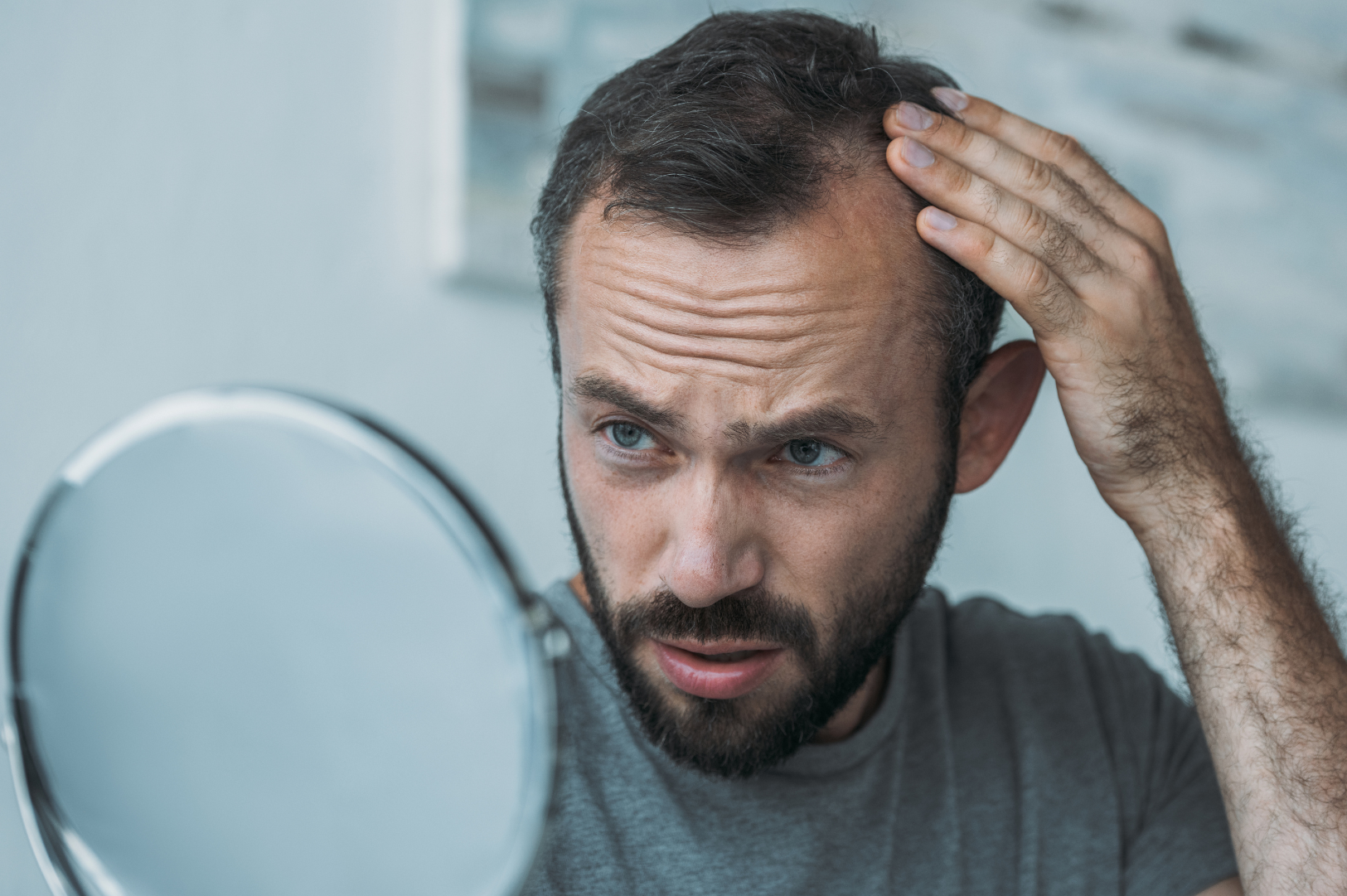 Male Pattern Hair Loss (Androgenetic Alopecia)