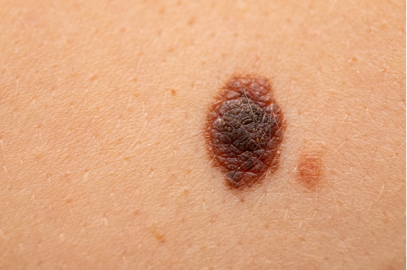 Melanoma